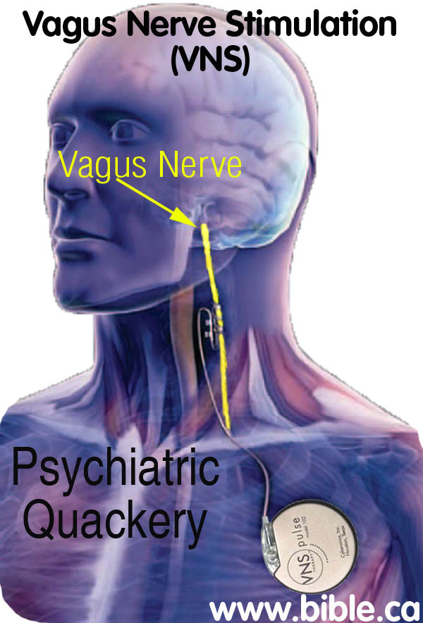 Vagus Nerve Stimulation (VNS): Mental Illness Depression, Brain Treatments